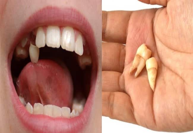 ฝันว่าฟันหัก ฟันหลุด ฟันแตก หมายถึงอะไร predict Broken tooth ลางบอกเหตุ ดีหรือร้าย !! 1